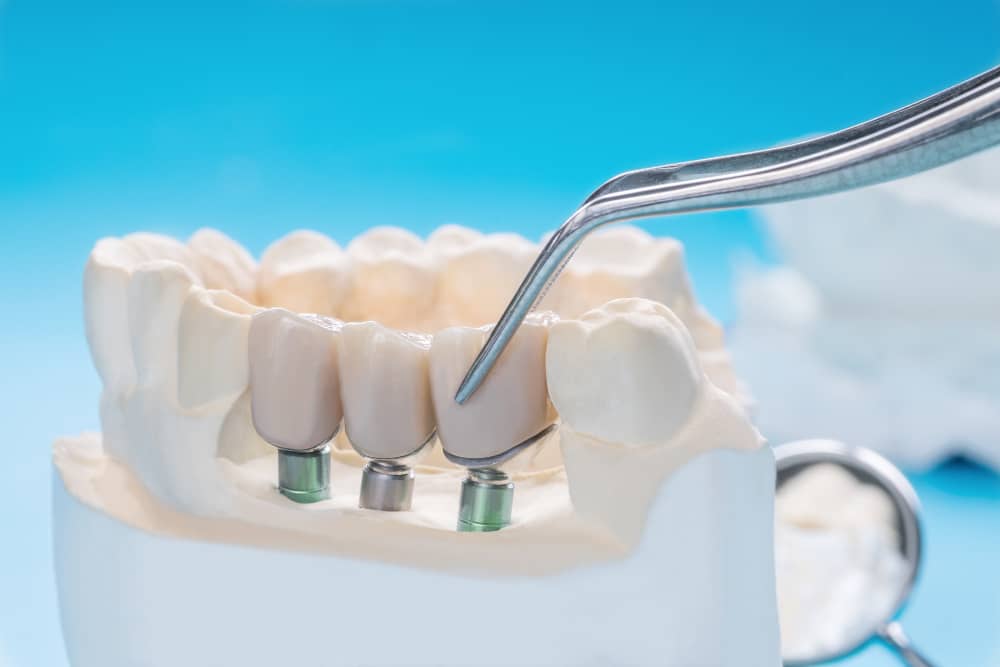 Modelo de implante dental puente fijación de corona